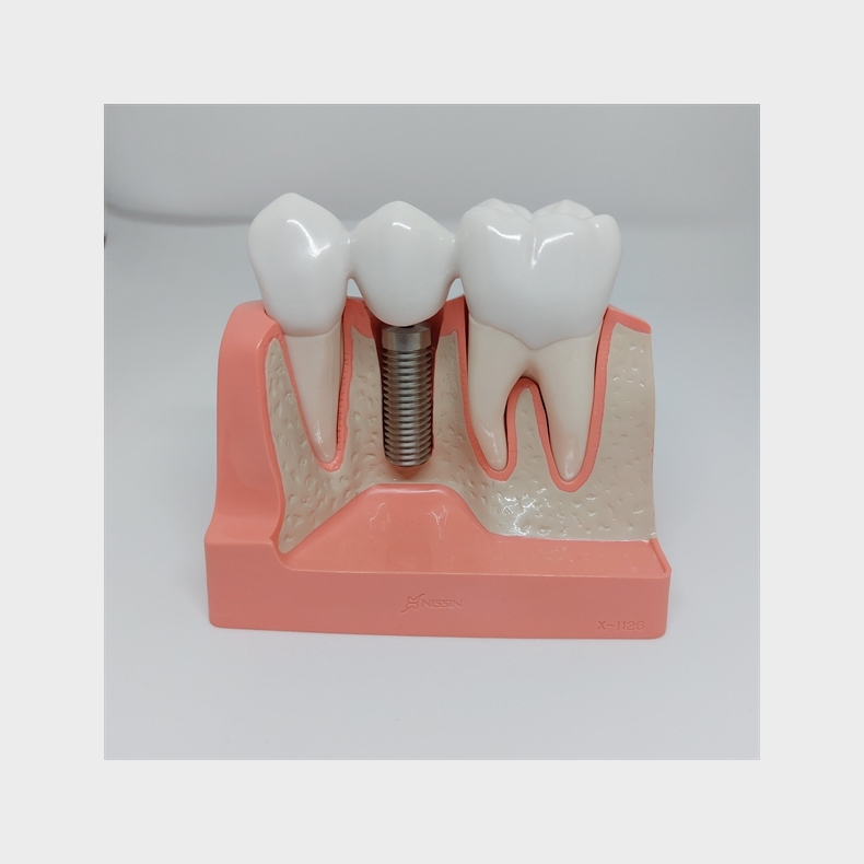 Maxi Implantat/Bro Studiemodel 